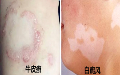 白癜风牛皮癣,牛皮癣白癜风的问题