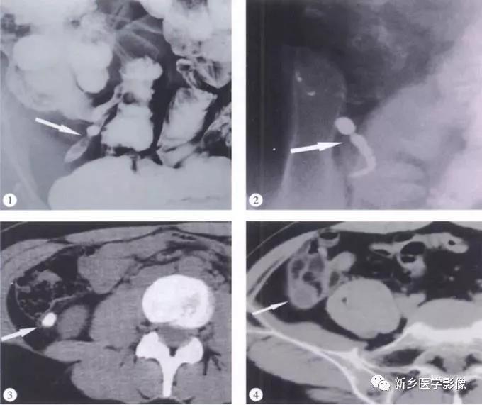 阑尾的ct解读与影像诊断技巧,阑尾影像学基础知识