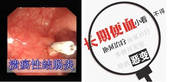 溃疡性结肠炎也会转化成癌？一旦出现这3种迹象，十有八九在癌变