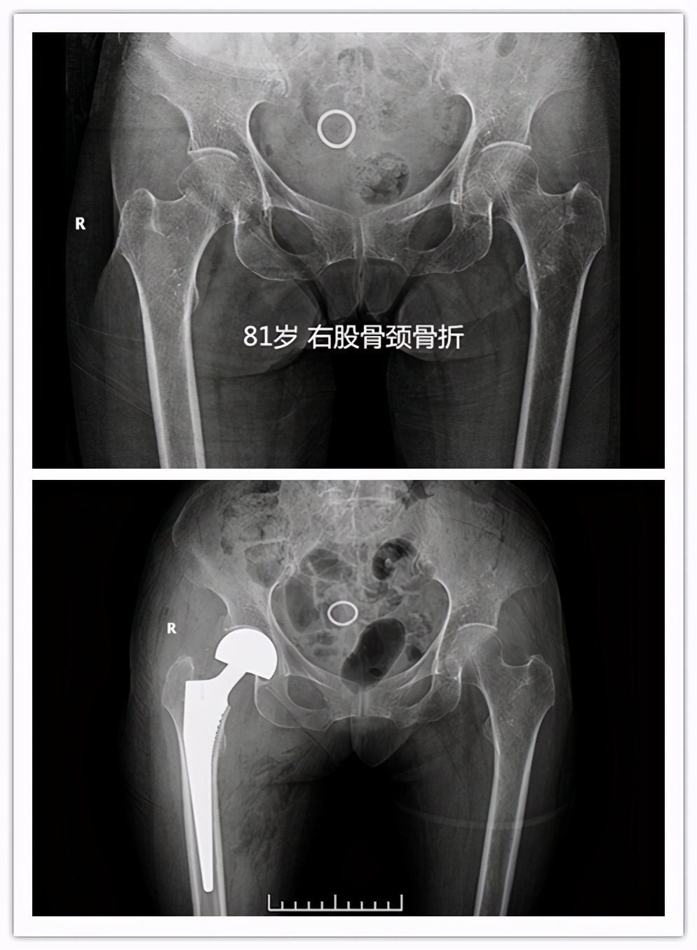 人生最后一次骨折原因,人生的最后一次骨折