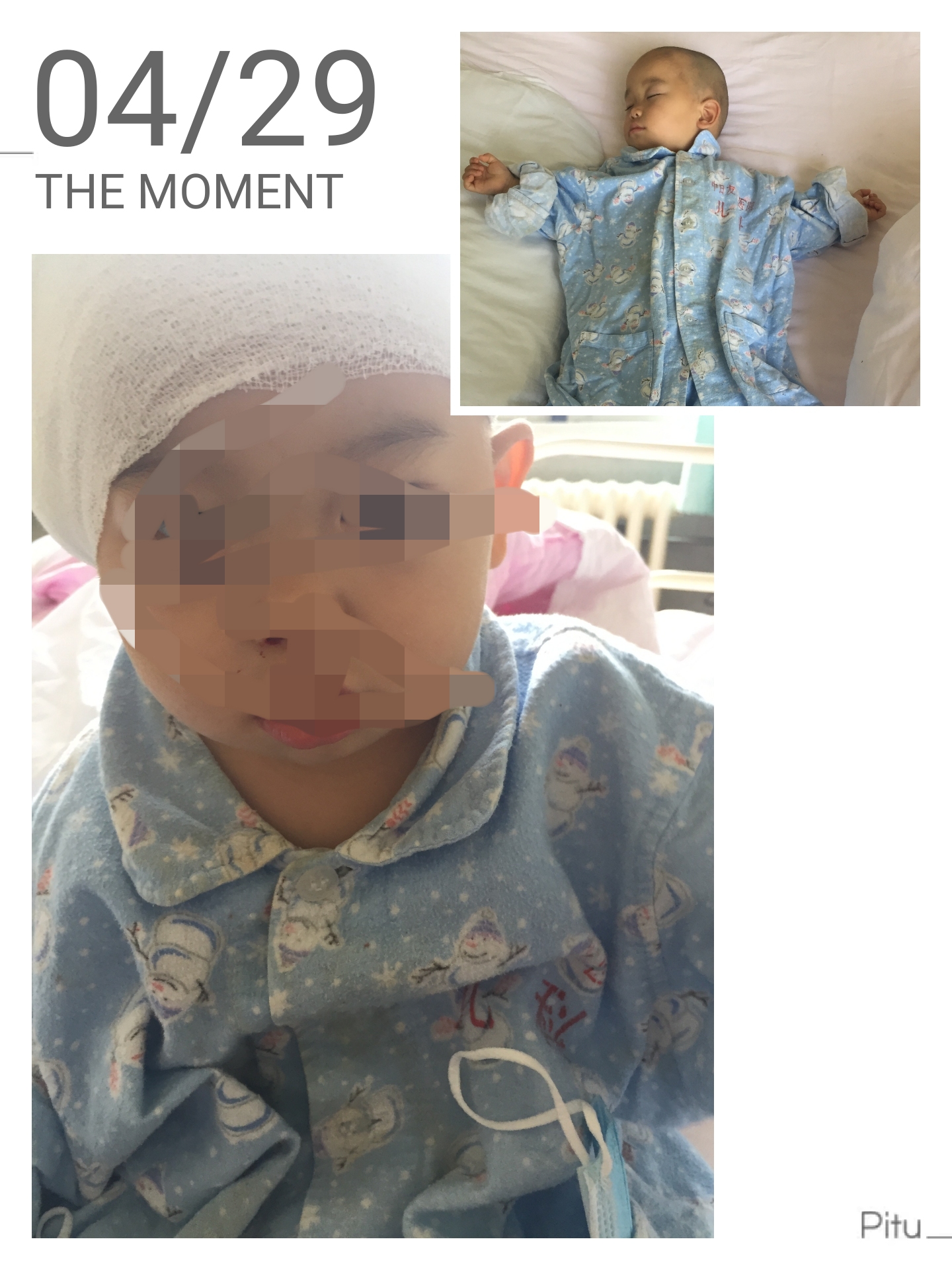 儿童耳聋申请免费人工耳蜗,先天耳聋宝宝可以申请免费耳蜗吗