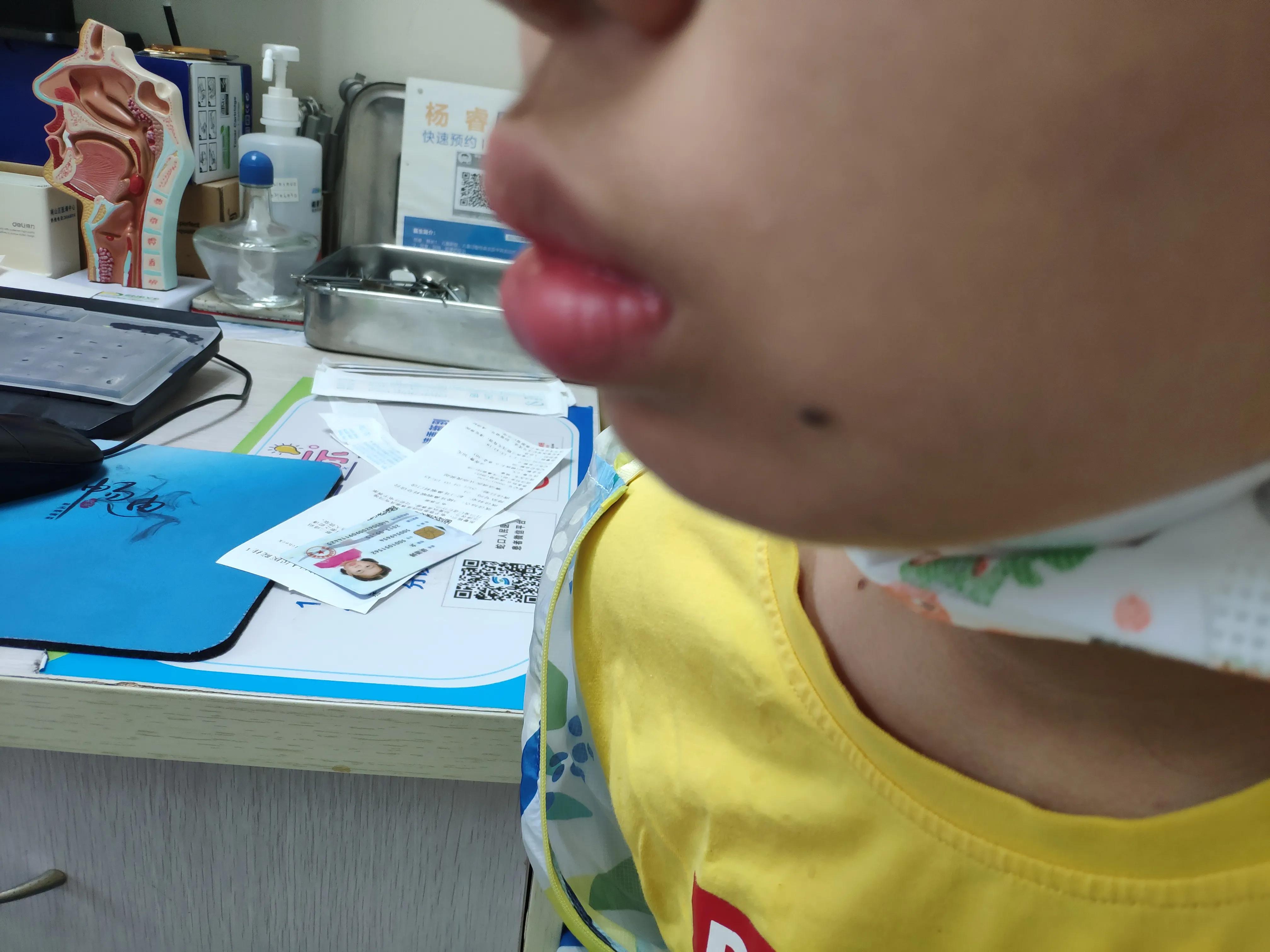 腺样体面容一定丑吗,腺样体面容患者16岁还会变丑吗