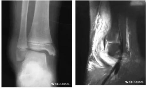 小孩手摔骨折打石膏后可以动吗,摔倒脚骨折需要打石膏吗
