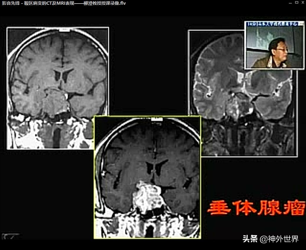 鞍区解剖学习笔记之——垂体