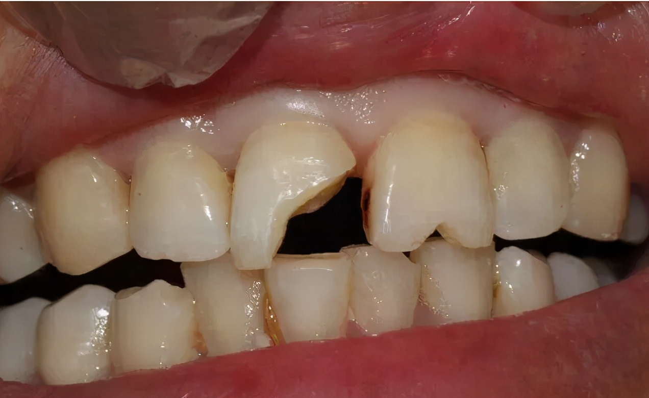 牙髓坏死了还能救回来吗？医生：这个技术很多人不知道