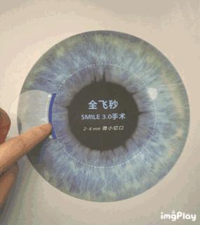 近视眼手术晶体移植和激光的区别,近视眼做了激光有什么利弊