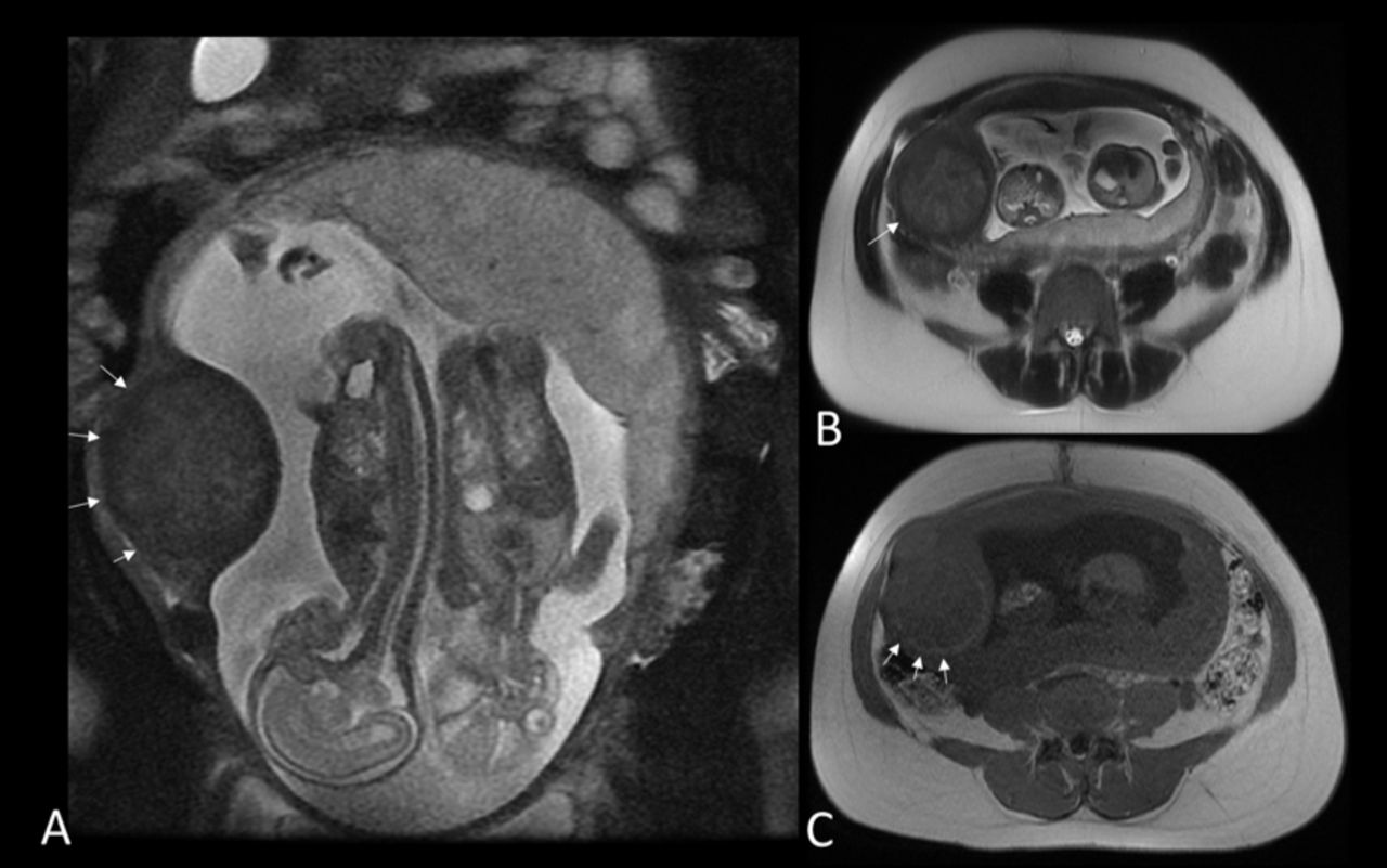 姝ｅ父鍙楀瓡鍜屽澶栧瓡鍙戠敓杩囩▼瀵规瘮,杈撳嵉绠″濞犵殑缁撳眬鏈夊摢鍑犵