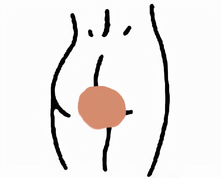 臀部上长个瘤子不疼不痒软软的,臀部上长一椭圆形不痛不痒的瘤子