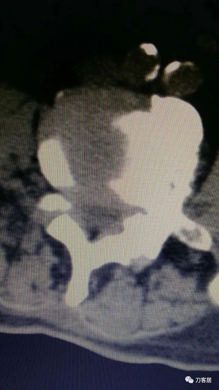 腰椎手术切掉棘突,腰突微创后出血肿