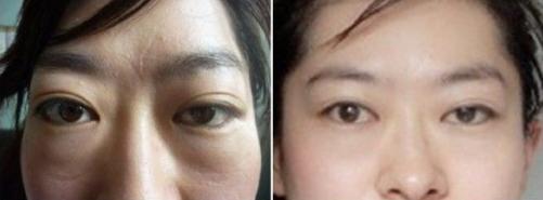 女人甲亢引起眼睛突出,甲亢恶性眼突视力模糊能恢复吗