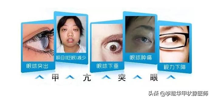 甲亢患者7大注意事项,甲亢注意哪些含碘食物