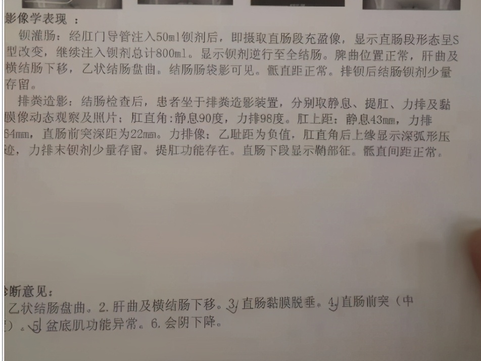 补中益气治疗脱肛,脱肛服用补中益气汤一般服多久