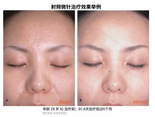 毛孔粗大缩毛孔最有效的方法,脸上毛孔粗大出油快速缩毛孔