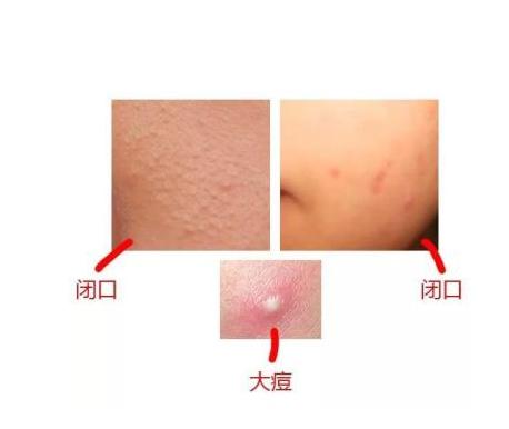 祛痘教材,教学祛痘