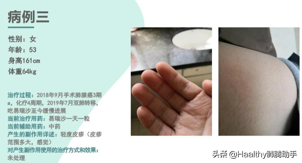 专家谈中医治疗肺癌方法,肺癌晚期放疗有什么副作用和危害