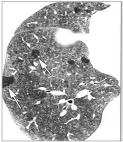 肺部ct十大征象,肺部ct正常图和异常图的区别