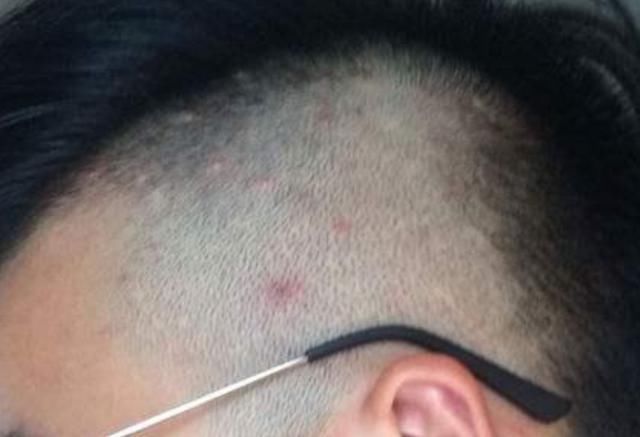 脱发没有毛孔了还能恢复吗,脱发后头发不长了怎么回事