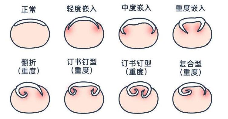 甲沟嵌甲从根部戳到肉里面怎么办,脚趾甲侧面嵌甲自己怎么处理
