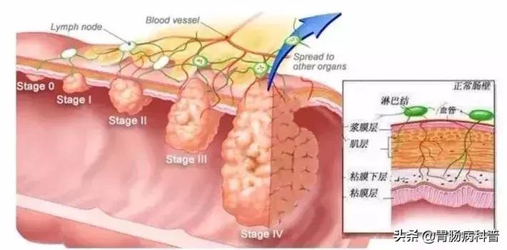 增生性肠息肉切除后几年复查合适,肠息肉0.6厘米切除后多久再复查