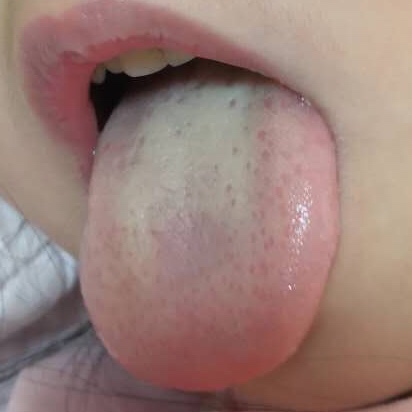 小孩如何通过舌象判断感冒,胃病反反复复看舌象