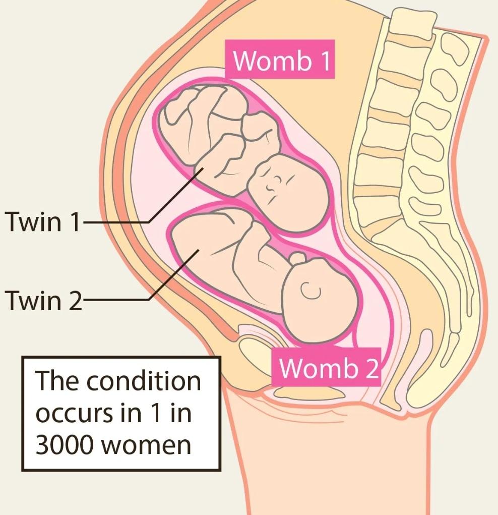 英国女子拥有两子宫，检查发现孕有双胞胎，概率仅为五千万分之一