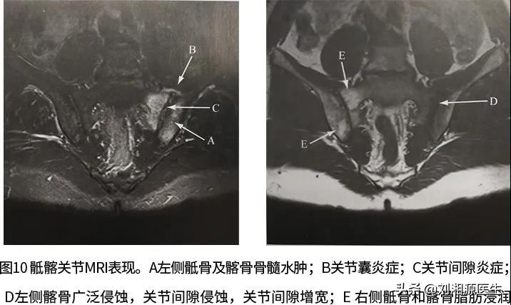 免疫相关不良妊娠答疑解惑,怀孕如何避免强直性脊柱炎