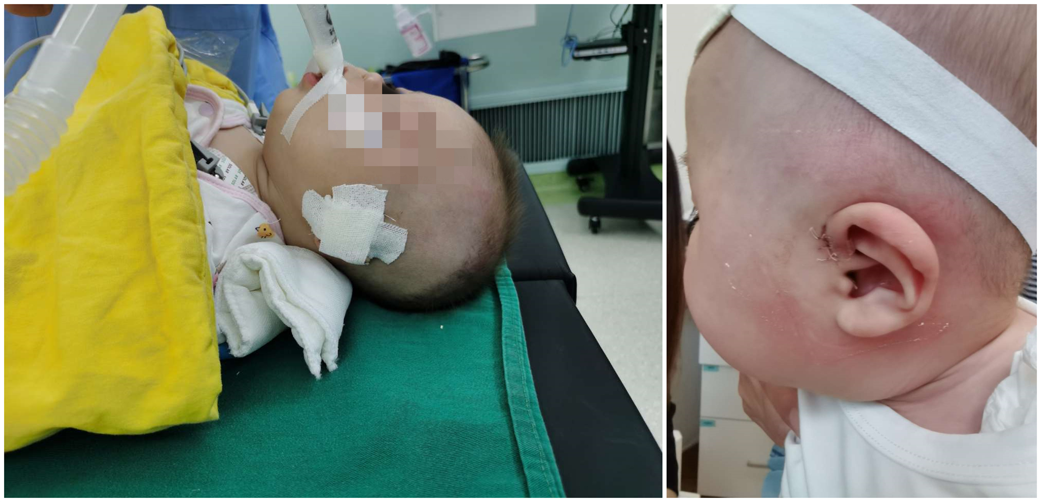 耳前瘘管手术宝宝,7个月宝宝有耳前瘘管可以手术吗