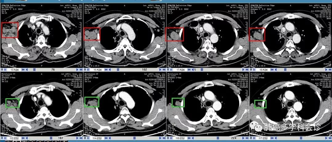 aacr肺癌高发,小细胞肺癌abc临床试验