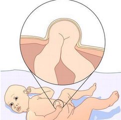 宝宝脐疝有什么症状,宝宝脐疝的症状及表现