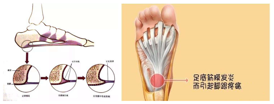 骨刺与跖筋膜炎怎么治疗,足跟痛骨刺与跖筋膜炎