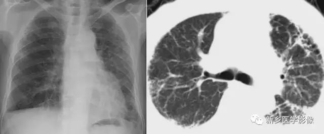 肺部基础免疫,肺基础疾病有哪些
