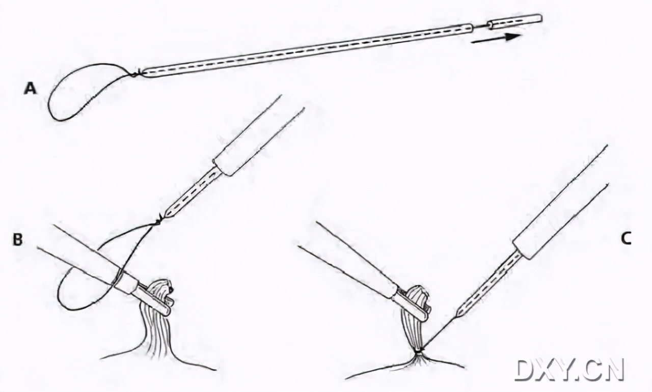 腹腔镜下切割缝合器使用视频,腹腔镜下缝合教程