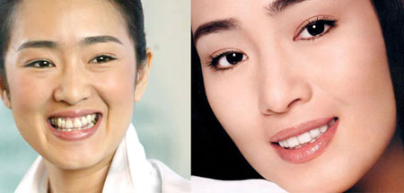 吴宣仪烤瓷牙怎么做,吴宣仪的整牙前