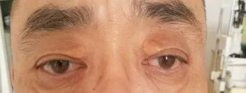 眼整形修复权威科普,科普眼整形手术是个什么手术多图