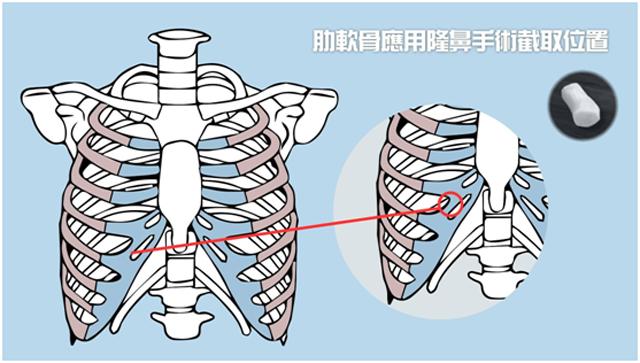 鼻整形案例分享注射隆鼻术,朝天鼻耳软骨假体隆鼻过程