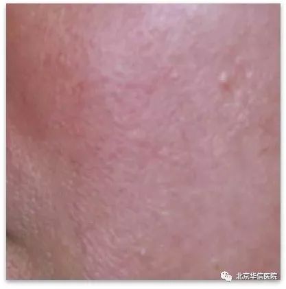 光子嫩肤帮你逆袭光滑细嫩状态,光子嫩肤让你拥有蛋壳般肌肤