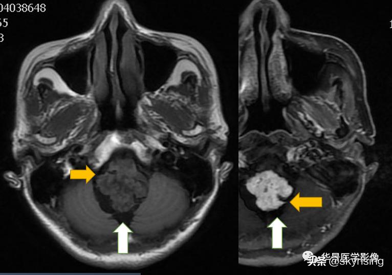 椎体侵袭性血管瘤mri影像学表现,中年妇女脑部血管海绵体瘤的症状