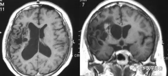 脑室影像学表现,脑室占位影像