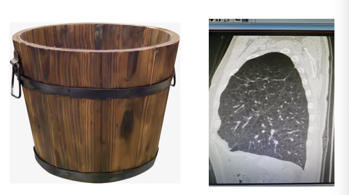 慢阻肺是桶状胸,慢阻肺会出现桶状肺吗