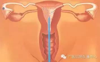 科普人工授精,人工授精科普