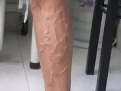 小腿有湿毒怎么办,小腿积累毒素