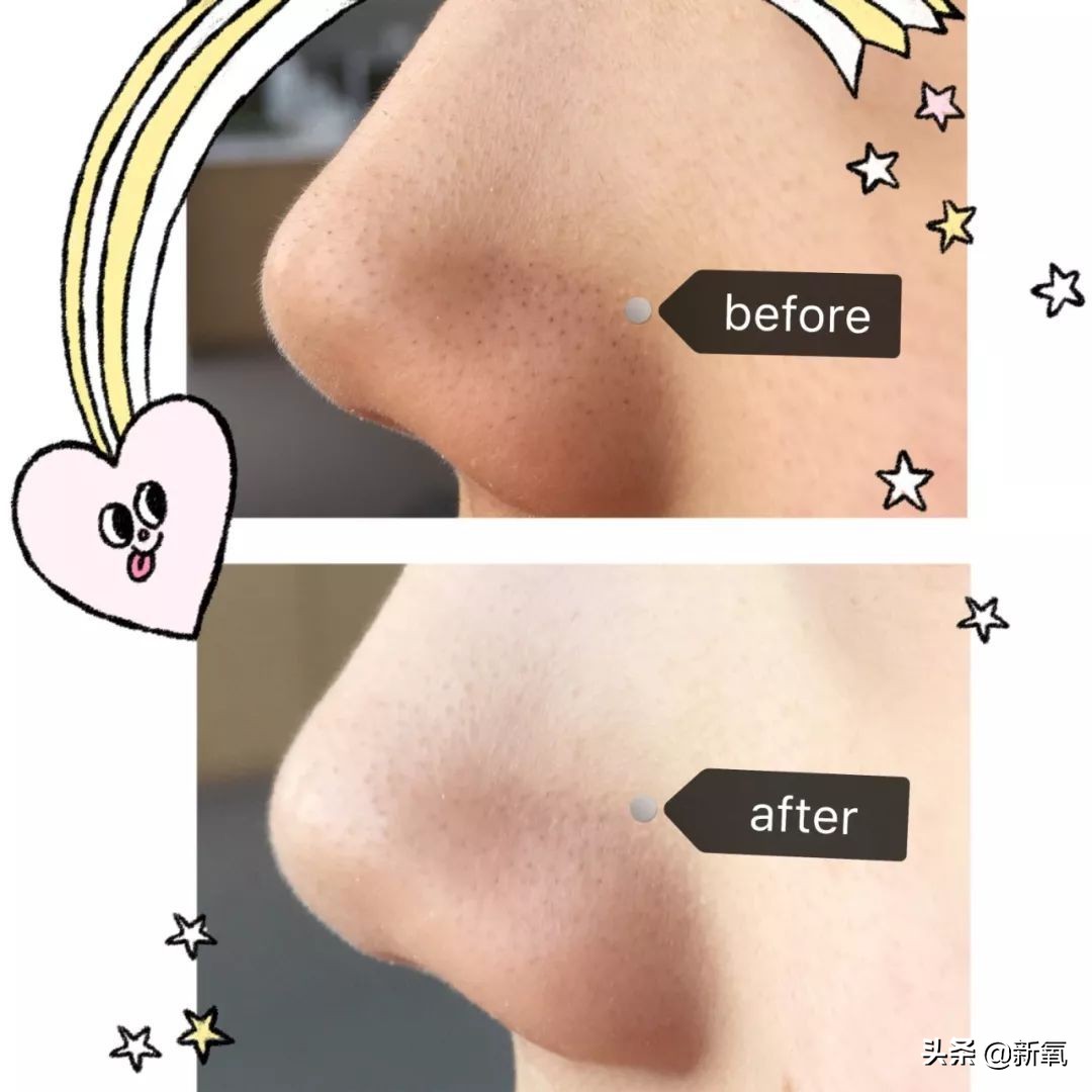 五分钟教你有效去黑头,最火去黑头收缩毛孔