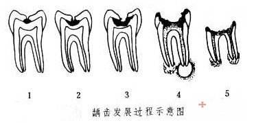牙齿吃东西感觉酸软无力怎么办,牙齿酸软咀嚼食物无力吃什么药