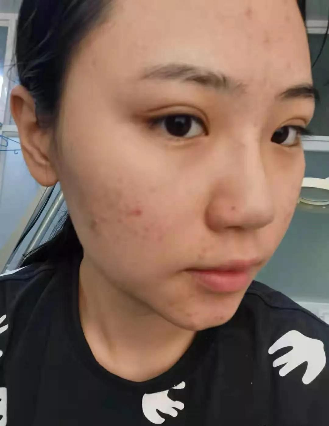 去皮肤科医院看痘痘,北京看痘痘好的皮肤科医院