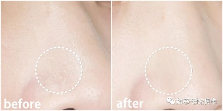 黑头去除神器排行榜,黑头粉刺清除强力推荐网红产品