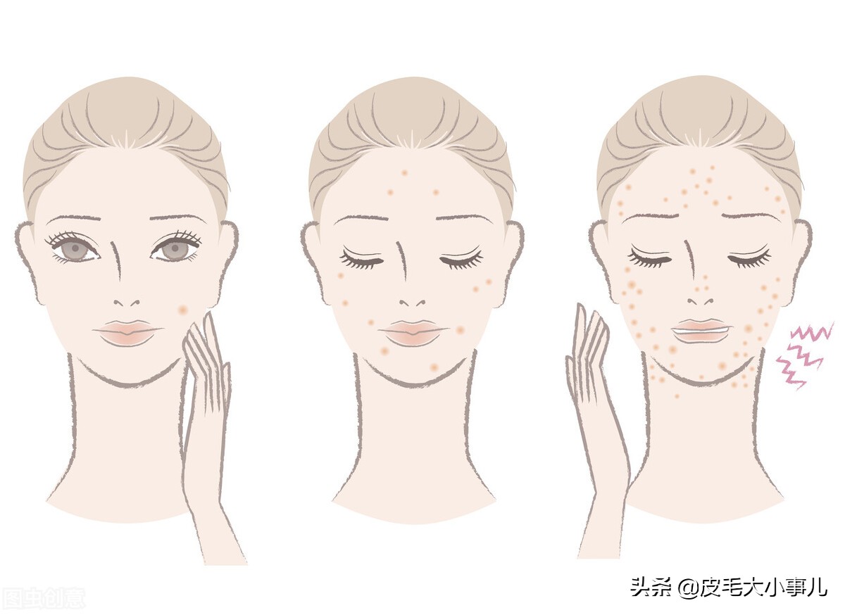 油痘肌是用vc还是a醇,油痘肌可以用视黄醇吗