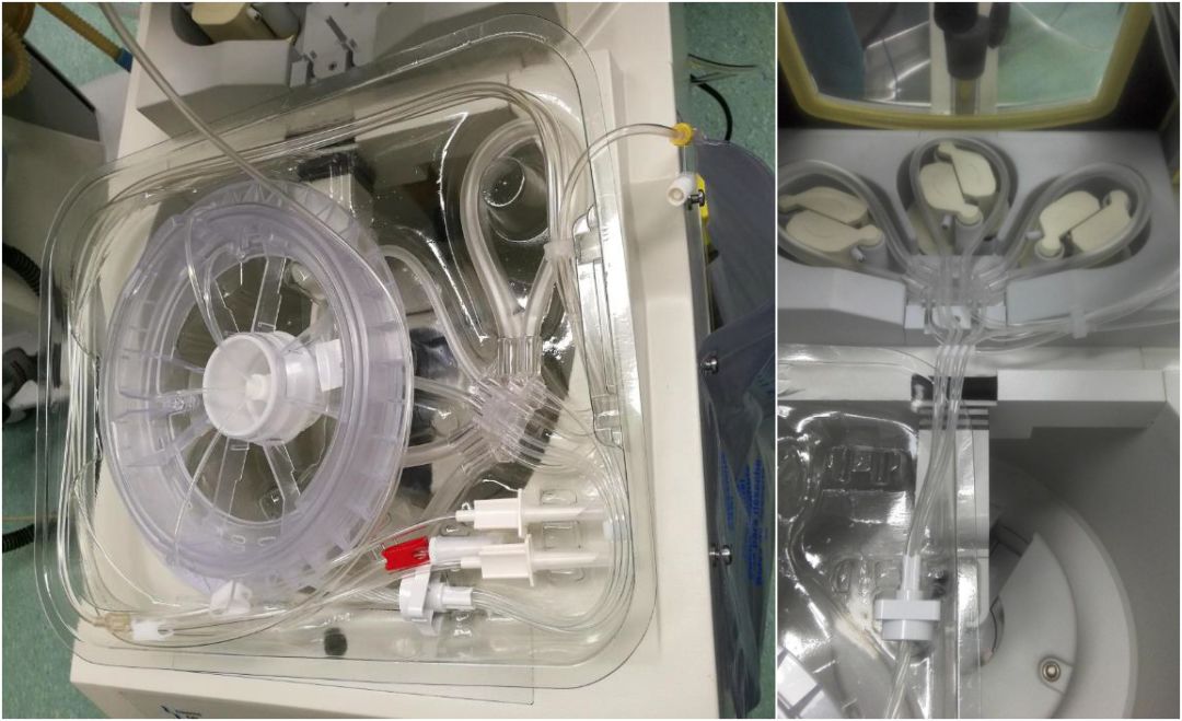 马康:术中自体血液回收