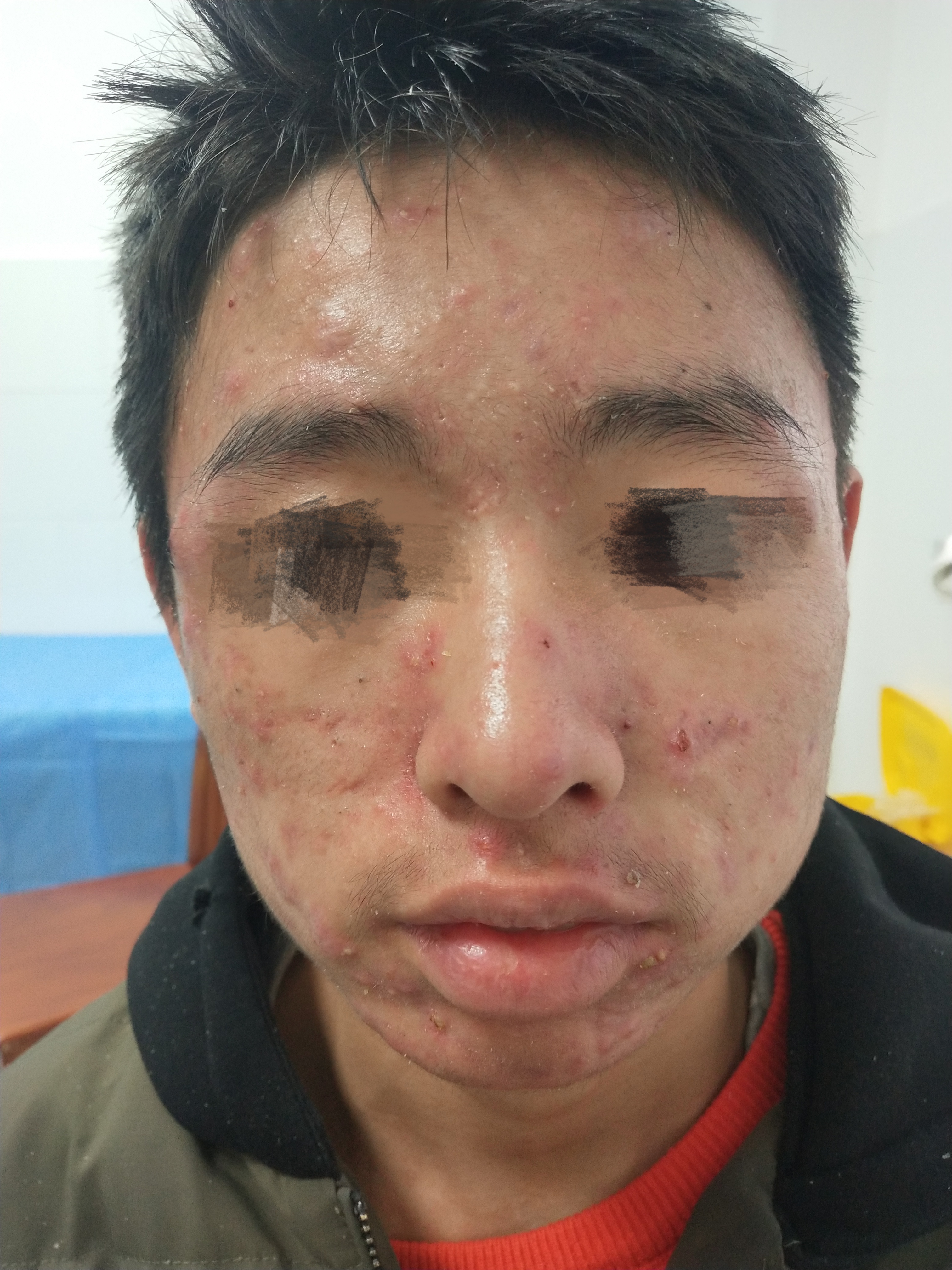 16岁男孩子脸部痘痘严重,16岁男孩身上长痤疮怎么治疗