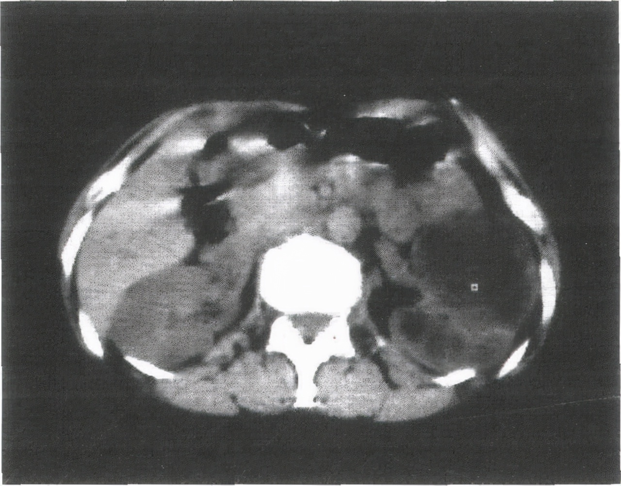钙化是否说明病已好了,如何知道钙化呈现什么形状