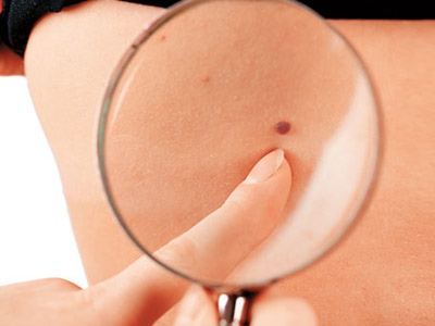 先天性色素痣多大治疗比较好,色素痣的治疗方法都有哪些呢